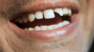 rbh5h56uj5 300x167 دلایل مهم شکستن دندان چیست؟